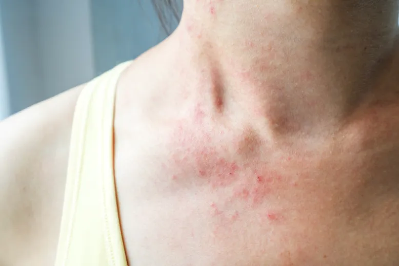 妊娠中の発疹が母体に与える影響