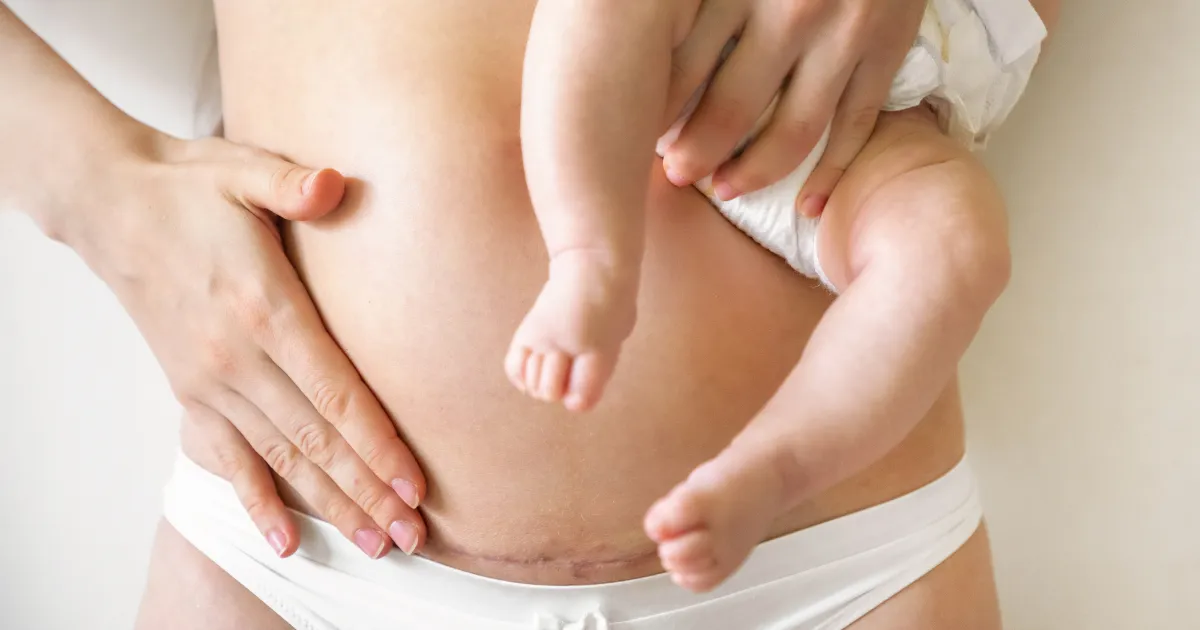Foods to avoid after a C-section